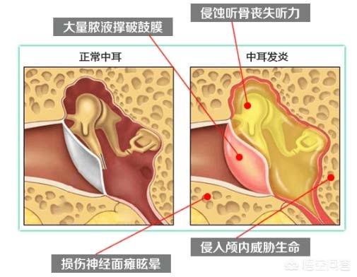 男童感冒后急性中耳炎吃什么药:小儿中耳炎怎么治疗？ ？