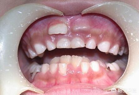 宝宝出牙前的牙床图片图片