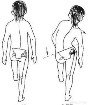 先天性髋关节脱位:48天宝宝髋关节脱位可以治愈吗？