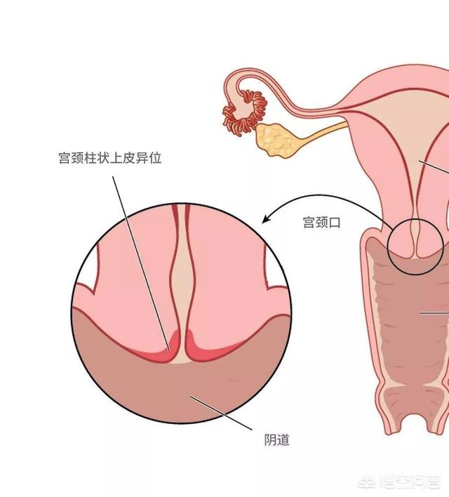 宮頸糜爛影響生育嗎