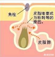 什么方法去黑头比较有效果，1、	你觉得真正有效的去黑头方法有哪些