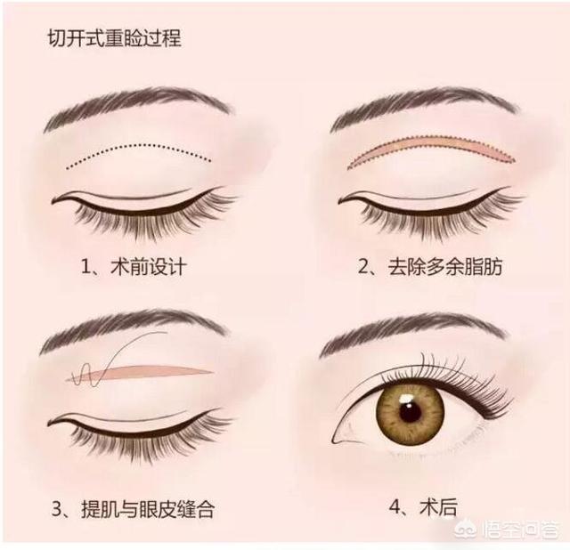 古巨基割双眼皮:为什么女的要整形成双眼皮