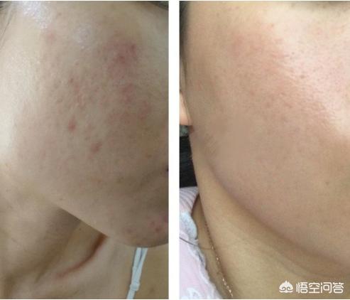 皮肤发红怎么办:脸部皮肤发红发痒怎么办 秋冬皮肤泛红过敏要怎么办？