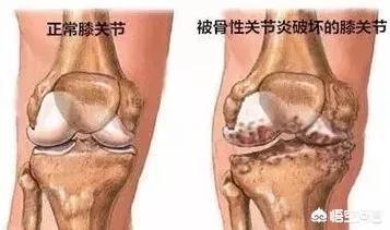指关节炎怎么治:指关节炎症如何治疗 关节炎的治疗方法有哪些？