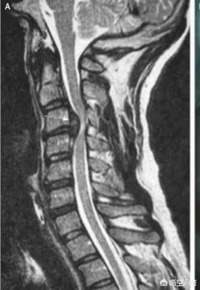 头条问答 做磁共振 颈椎3 4节突出还压迫到了神经 该怎么办 104个回答