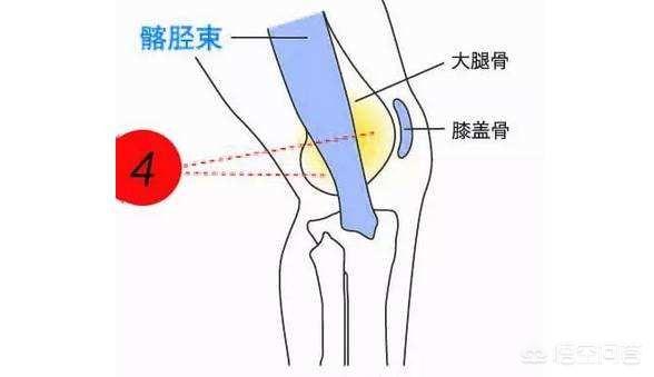的内翻或者外翻,主要是大腿内收肌和髂胫束的不平衡为主,试着找到痛点