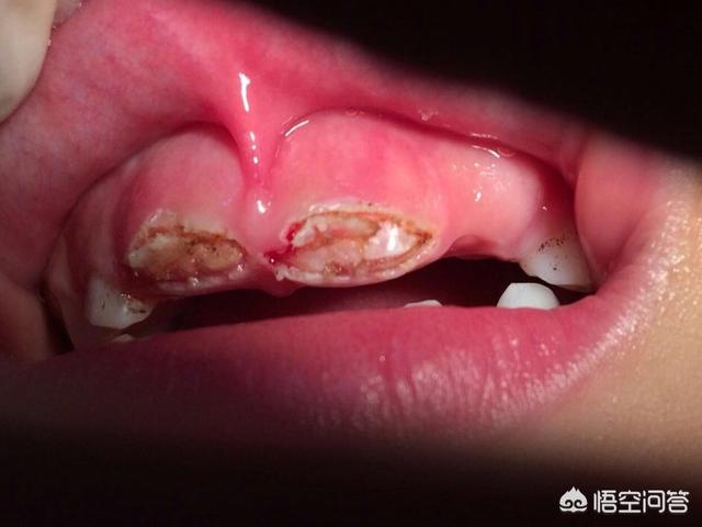 七岁半孩子门牙在牙龈中半年,一直长不出来是怎么回事?