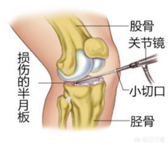 膝盖半月板骨裂怎么办:膝半月板撕裂怎样治疗 双腿半月板损伤，现在一走路就裂开痛，且有声响，怎么办？