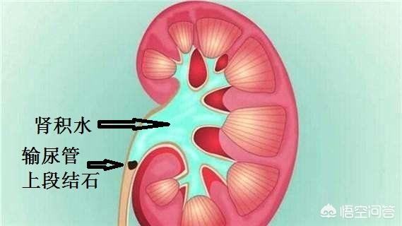 得了肾结石肾严重积水应该怎么办
