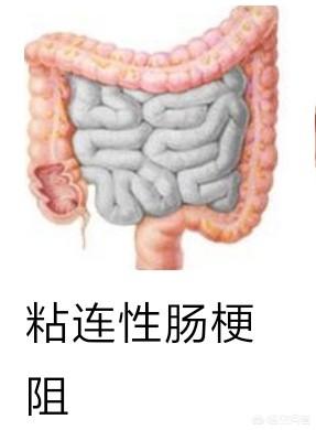 海龟肠梗塞的治疗:除了手术还有其他治疗肠梗阻的办法吗？ 肠梗塞一般要治疗多少钱