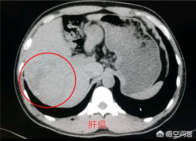 仑伐替尼最新价格,现在的医学技术可以治好肝癌吗？