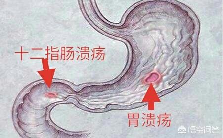 胃溃疡有哪些东西不能吃啊？