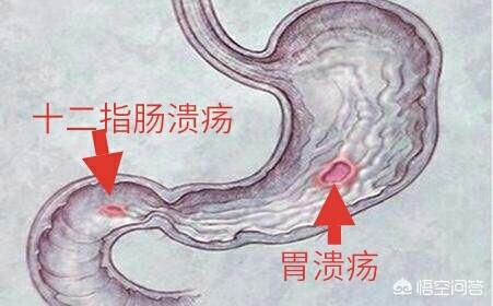 胃溃疡症状表现有哪些:胃溃疡,胃管炎有什么症状(胃炎是胃溃疡吗)