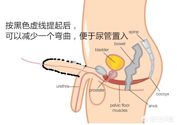 插尿管痛吗?-骨科医生老牛的回答-头条问答