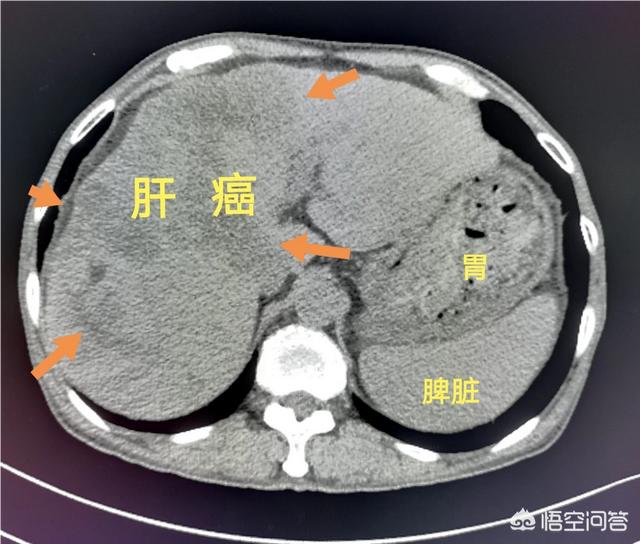 不影响寿命的十大癌症:癌症的最后结果都是死亡吗？有哪些注意事项？