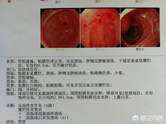 胃酸过多呕吐后吃什么:胃酸过多的人，早餐吃什么比较好？