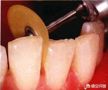 牙齿做了片切以后疼怎么办 牙齿片切如果切到了