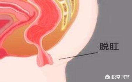 痔疮赘生物上长水泡，痔疮和赘生物的区别