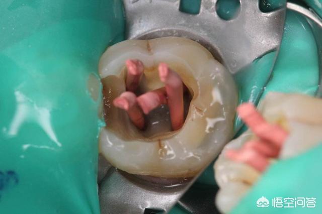 4.重度牙齿磨耗造成牙神经暴露者,需要杀牙神经.3.