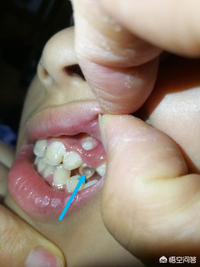 虎牙长在牙龈上方图片图片