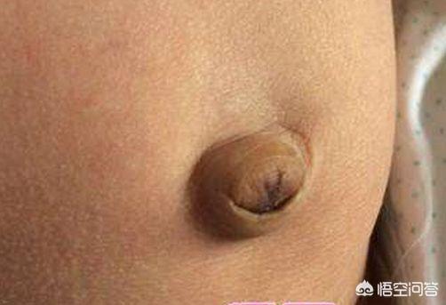 孕妇肚脐里的黑色硬物可以抠出来吗，孕妇肚脐眼里的黑色硬物可以抠出来吗
