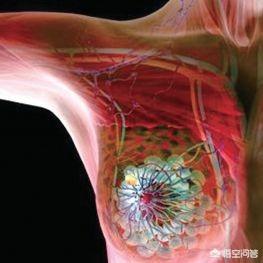 乳腺肿瘤症状有哪些,乳腺肿瘤有13厘米大是晚期吗？
