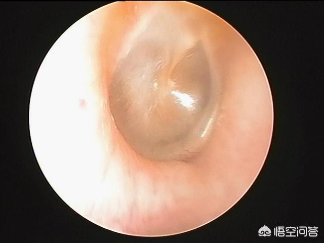 头条问答 - 鼓膜为什么会内陷,对听力有什么影响?(89个回答)