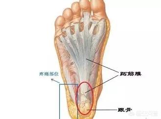 痛风脚后跟会痛吗没有碰着为什么脚后跟疼