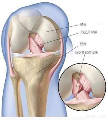 前十字韧带断裂 症状:太惨了！考辛斯前十字韧带撕裂，你怎么看？