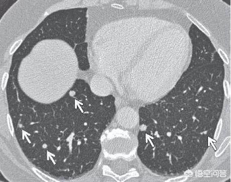 3个恶性肺结节:两肺都有恶性结节怎么办？