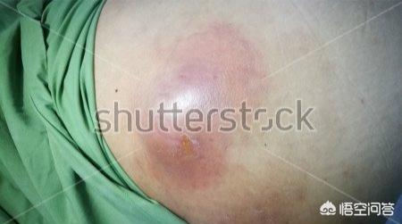 乳腺炎的症状:孩子戒奶期妈妈得了乳腺炎，该怎么办？