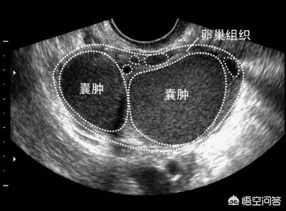 卵巢囊肿切了又长是什么原因呢