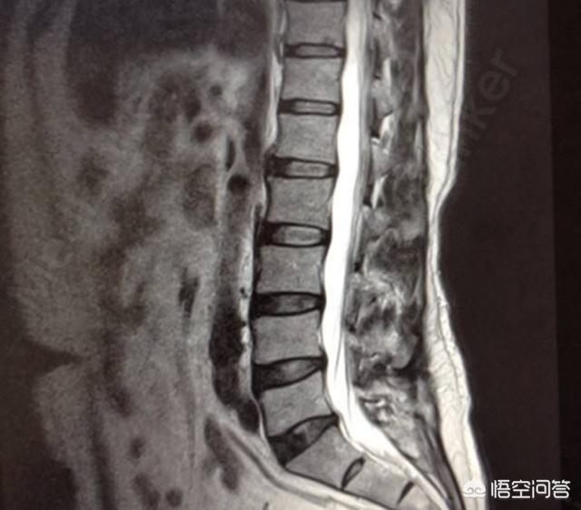 颈部牵引能使膨出恢复吗:腰间盘膨出压迫坐骨神经肌肉萎缩可以手术恢复吗？