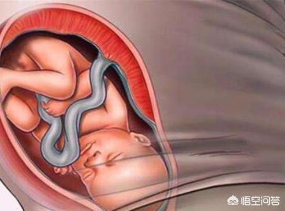 小腹下坠竟是脐带脱垂，哪些症状显示宝宝脐带脱落