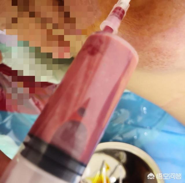 乳腺炎的症状:孩子戒奶期妈妈得了乳腺炎，该怎么办？