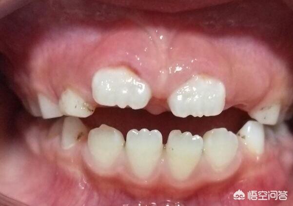 七岁半孩子门牙在牙龈中半年,一直长不出来是怎么回事?-育儿网