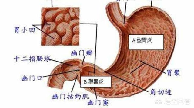 浅表性胃炎的症状及治疗:浅表性胃炎有哪些症状？治疗期间应该如何调理？