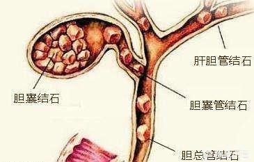 关于胆囊炎的症状:如何判断自己是否得了胆结石和胆囊炎？