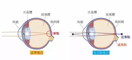 近视眼老花了怎么办(眼睛既近视又老花怎么办)