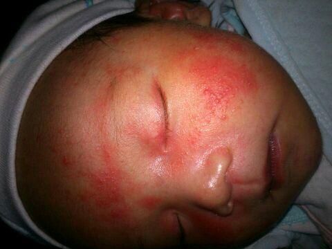 宝宝老是发奶藓因为宝宝是混合喂养不知道是不是奶粉的问题需要换奶粉