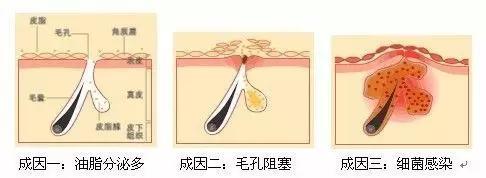 痘痘交流群:脸上的青春痘一直下不去，有什么办法彻底根治青春痘？