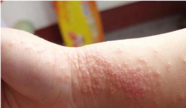 湿疹是因为什么原因引起的？