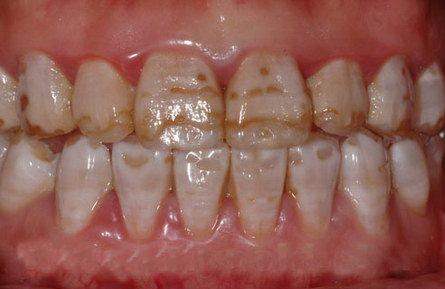牙间刷(牙间刷和牙线的区别)