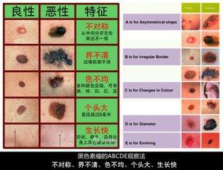 皮肤肿瘤疾病的元凶:皮肤癌症的早期症状是什么？