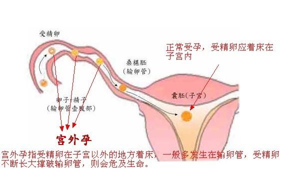 怀孕多久能知道自己是宫外孕:多久知道自己怀孕了 怎样才能在最短的时间知道是不是宫外孕？