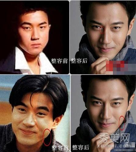 罗霈颖整容对比照:在韩国整容是不是很普遍的事情？