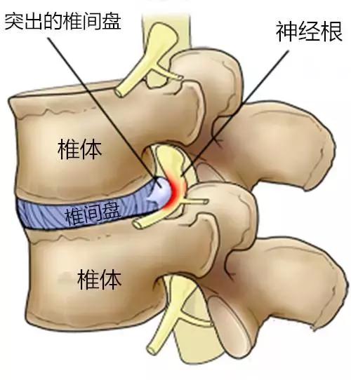 间歇性跛行:间歇性跛行见于什么病 腰间盘突出后可以引发别的什么症状？