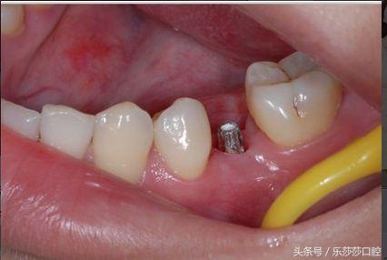 牙齿可以再生吗?如何保护牙齿?