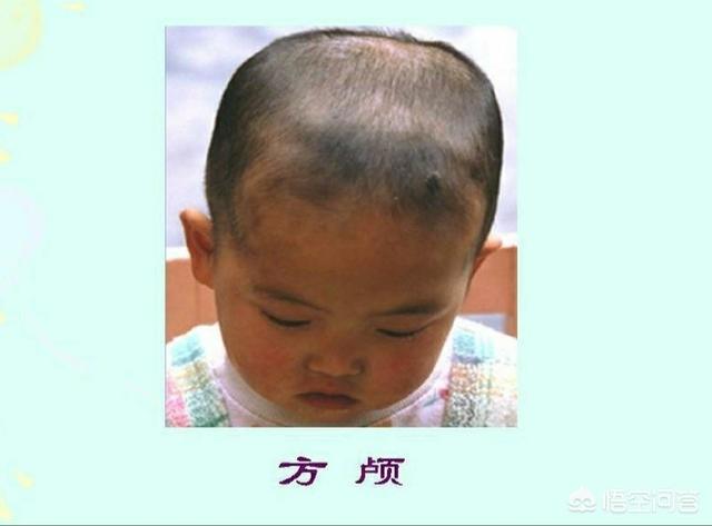 佝偻病症状:佝偻病症状表现 小孩子缺钙主要有哪些表现？
