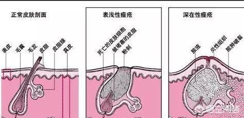 皮肤为什么会长痘痘？长痘痘该怎么办？